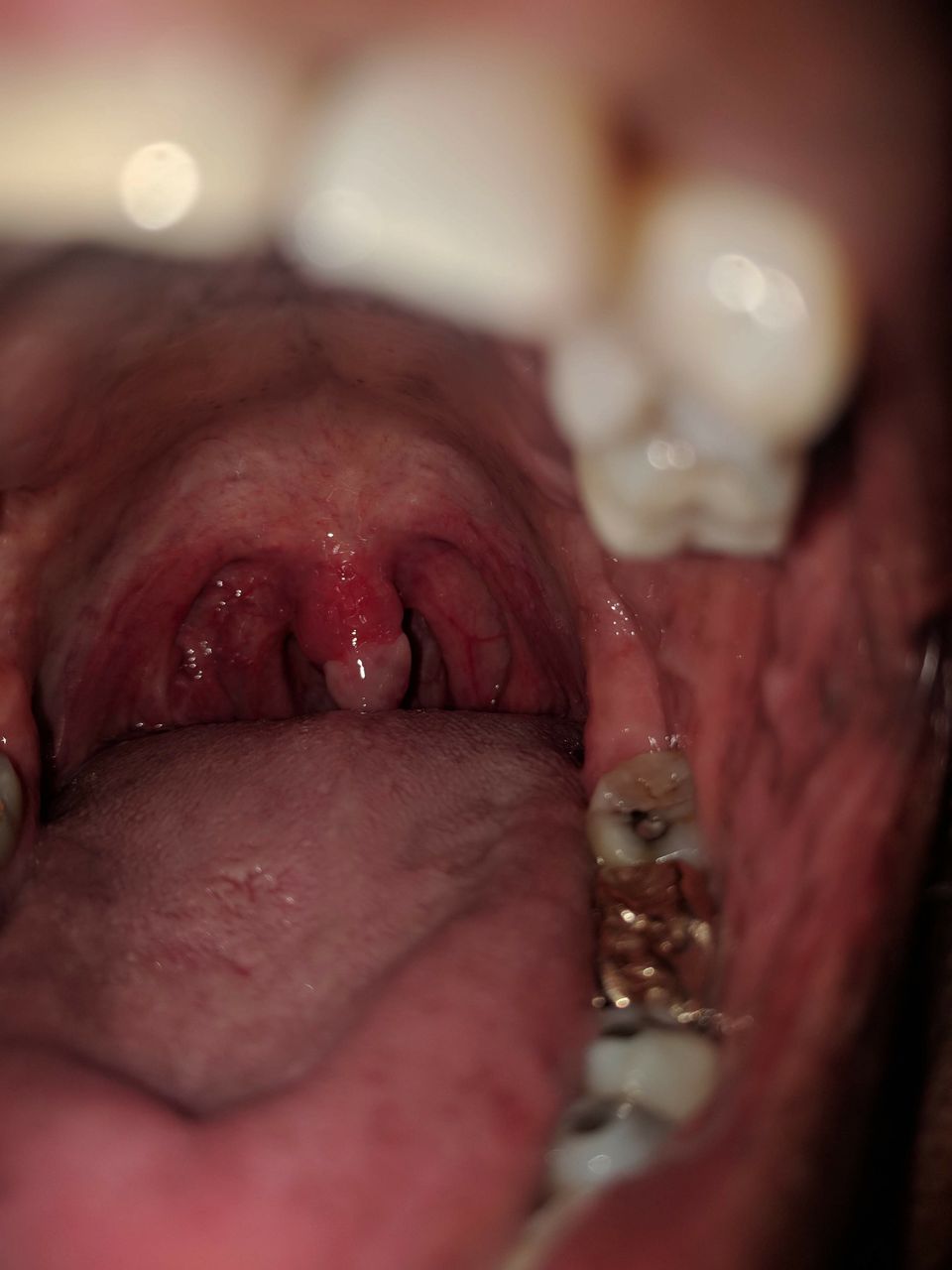 best of Uvula epiglottis throat